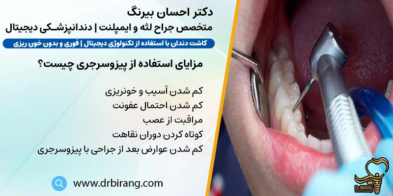 مزایای استفاده از پیزوسرجری در دندانپزشکی توسط دکتر احسان بیرنگ