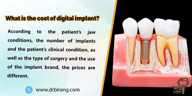 What is the cost of digital implant? 