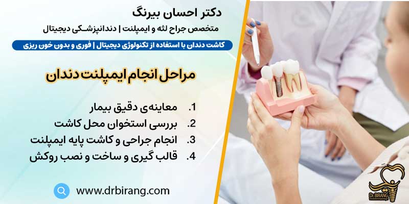 مراحل انجام ایمپلنت دندان | دکتر احسان بیرنگ متخصص ایمپلنت در تهران