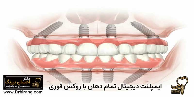 ایمپلنت دیجیتال تمام دهان با روکش فوری | دکتر احسان بیرنگ متخصص ایمپلنت تهران