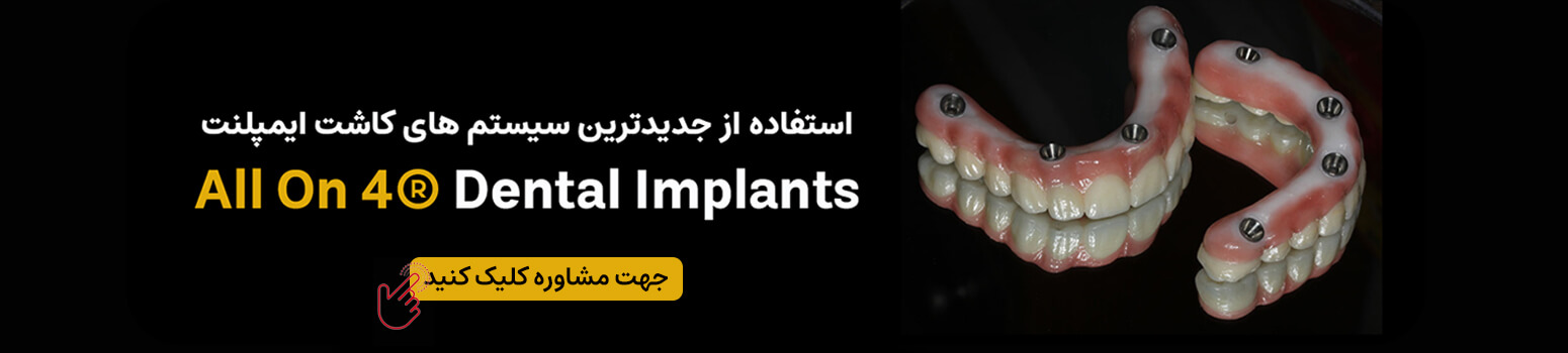 ایمپلنت دندان all on 4توسط دکتر احسان بیرنگ