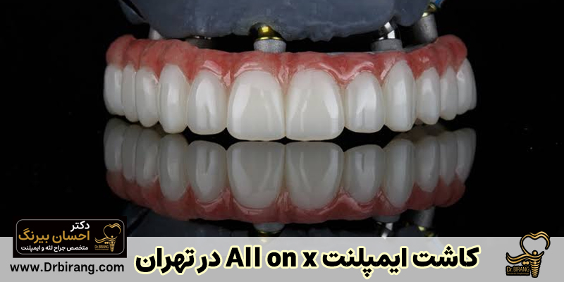 کاشت ایمپلنت all on x در تهران | دکتر احسان بیرنگ
