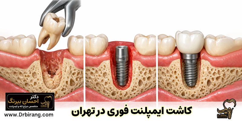 ایمپلنت فوری در تهران | دکتر احسان بیرنگ متخصص ایمپلنت فوری