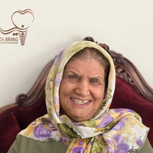 کاشت ایمپلنت برای خانم توسط دکتر بیرنگ در تهران زعفرانیه