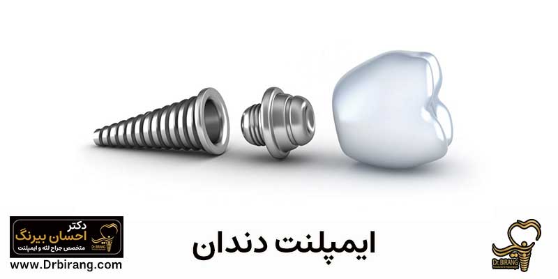 متخصص ایمپلنت دندان تهران | دکتر احسان بیرنگ