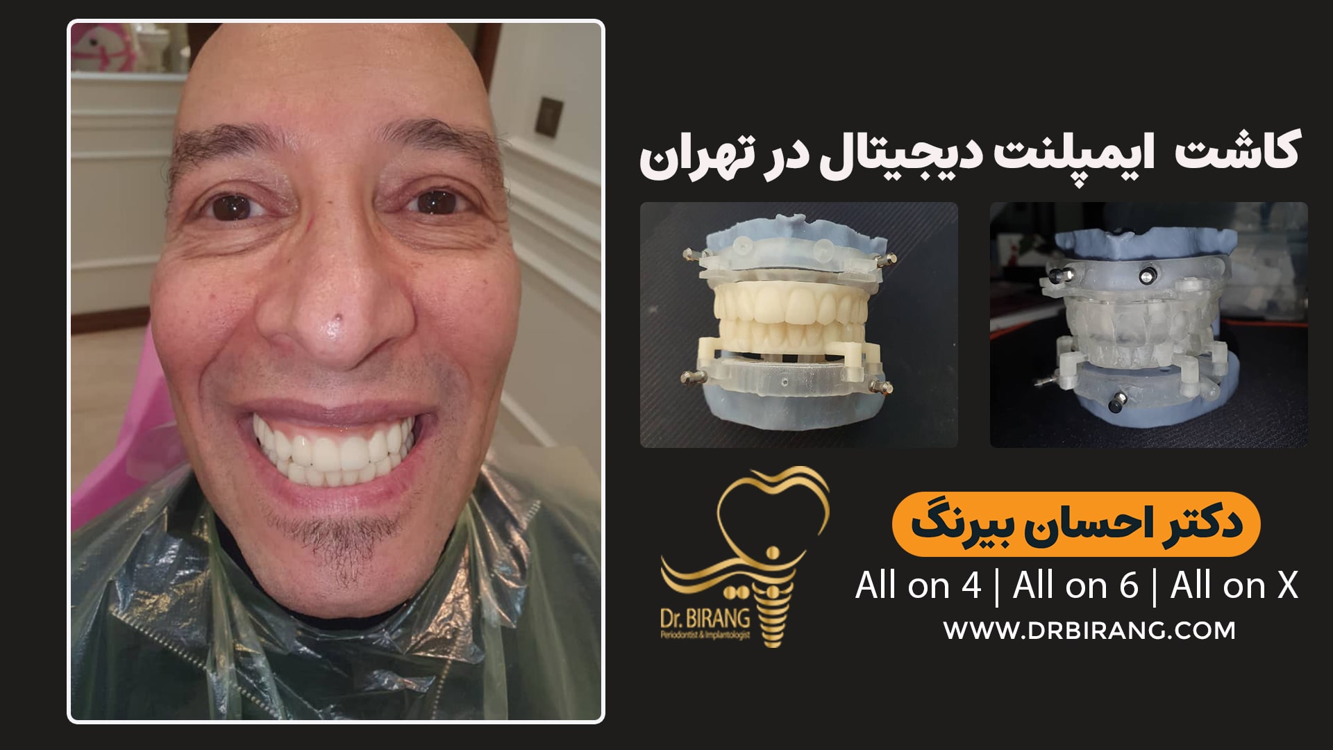 کاشت ایمپلنت دیجیتال در تهران| دکتر احسان بیرنگ