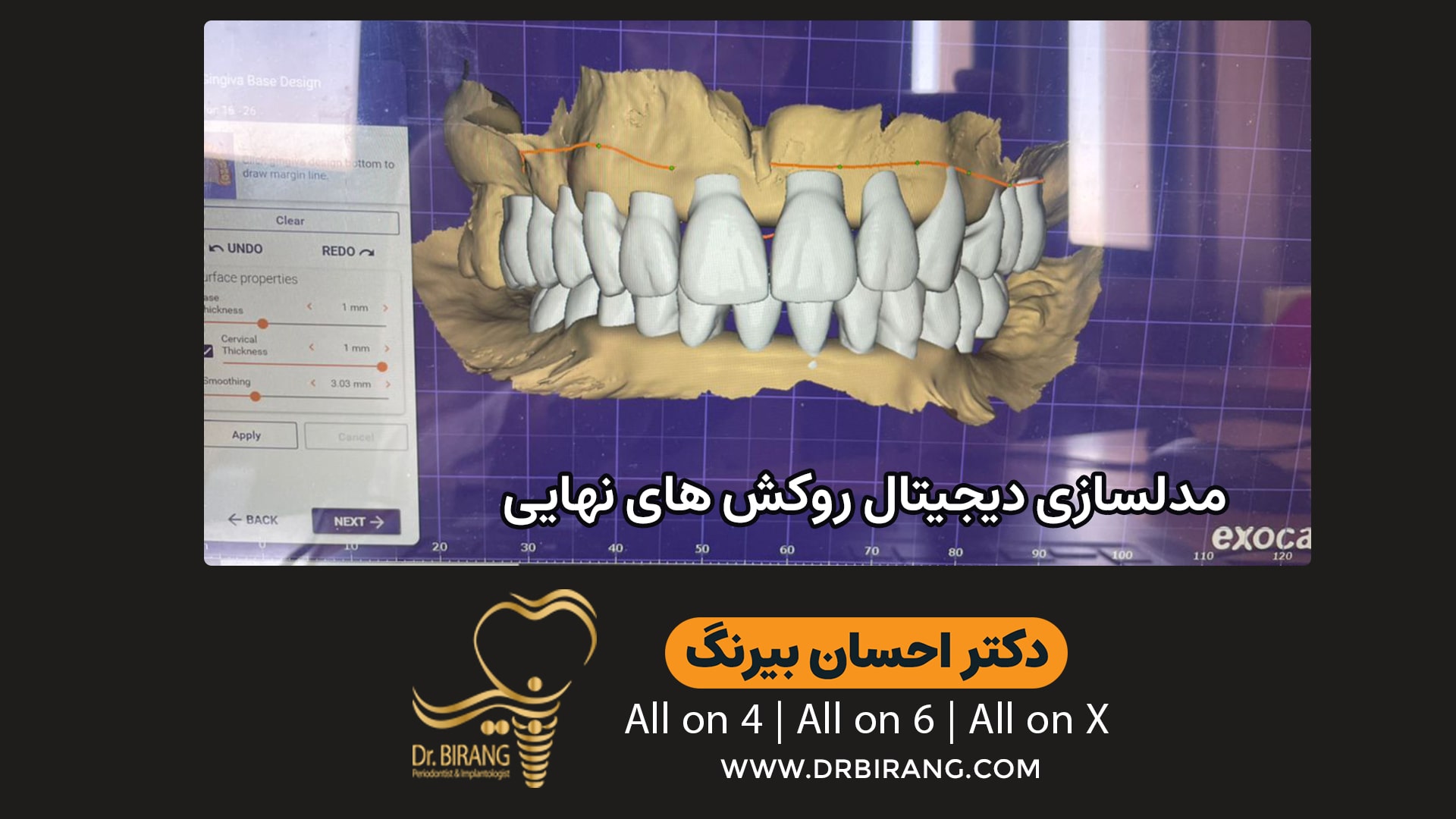 مدلسازی دیجیتال روکش های تهایی دندان | دکتر احسان بیرنگ متخصص ایمپلنت در تهران