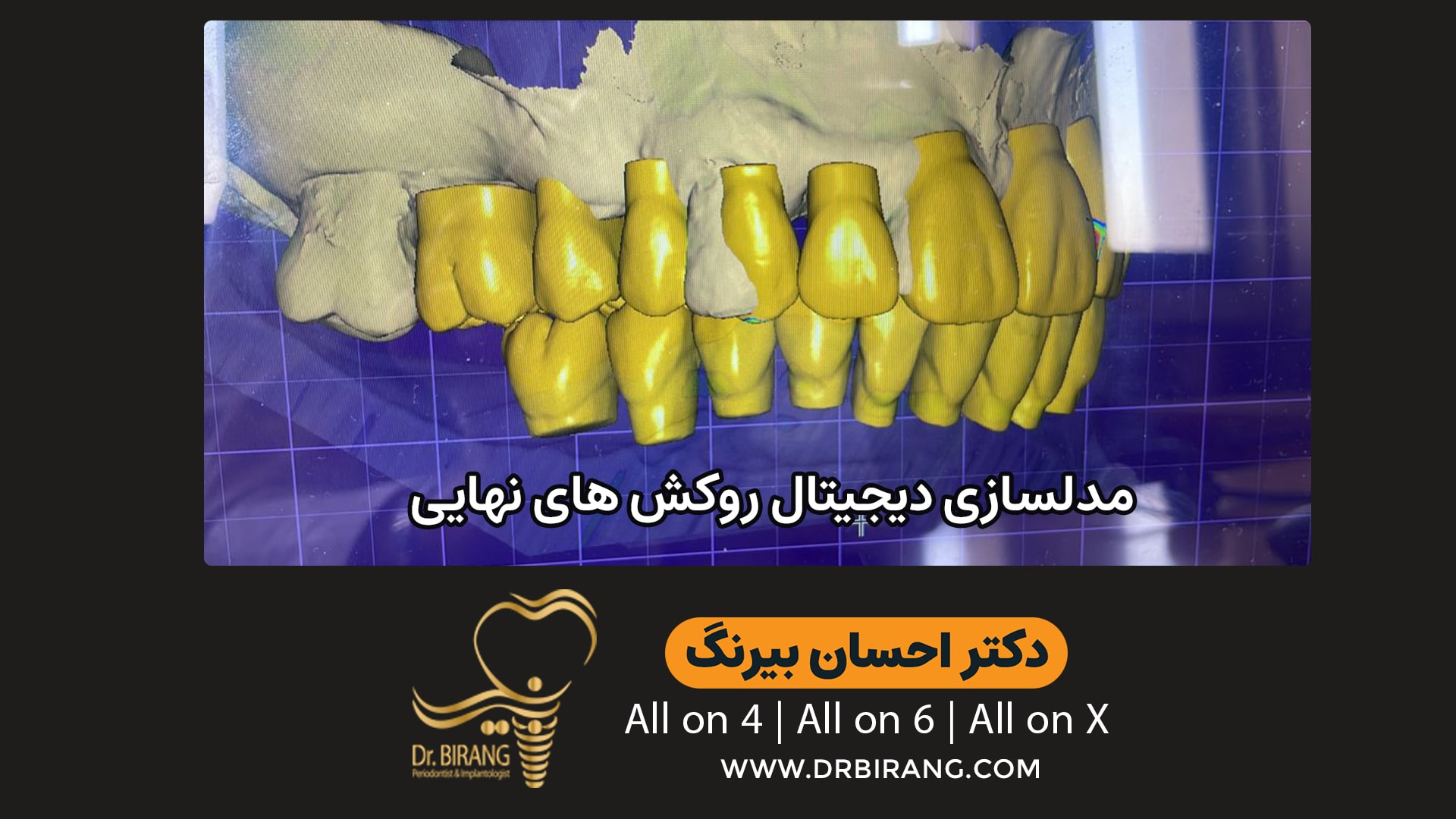 مدلسازی کاشت دندان با تکنیک دیجیتال برای بیماران خارج از کشور | دکتر احسان بیرنگ متخصص ایمپلنت در تهران