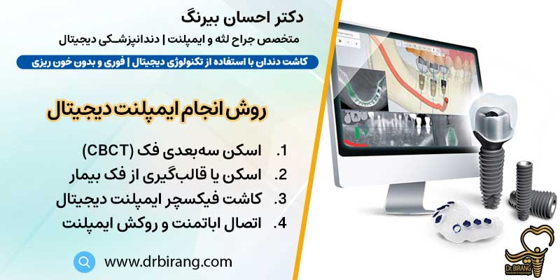 روش انجام ایمپلنت دیجیتال | دکتر احسان بیرنگ متخصص ایمپلنت دیجیتال در تهران