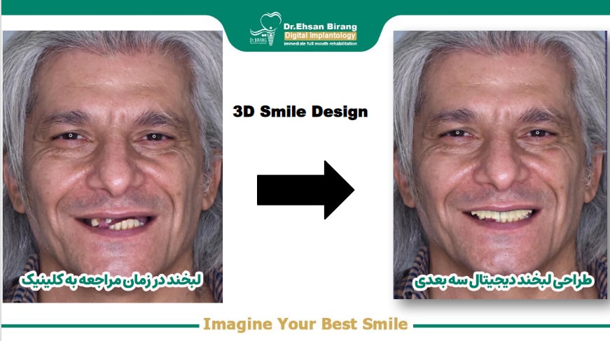 شرایط دندانی بیمار قبل و بعد از انجام ایمپلنت all on x توسط متخصص ایمپلنت دکتر بیرنگ