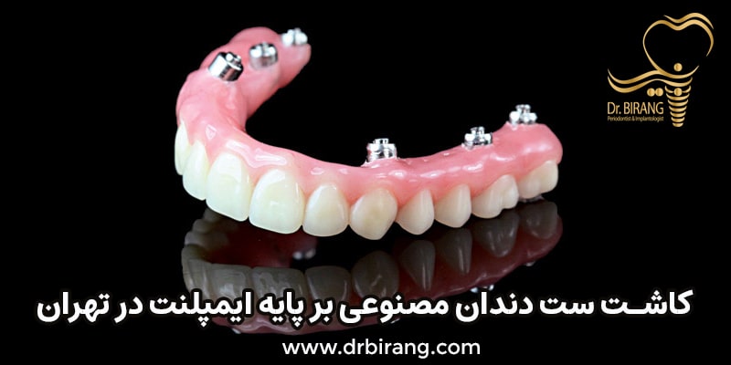 کاشت ست دندان مصنوعی بر پایه ایمپلنت در تهرن توسط دکتر احسان بیرنگ متخصص ایمپلنت تهران
