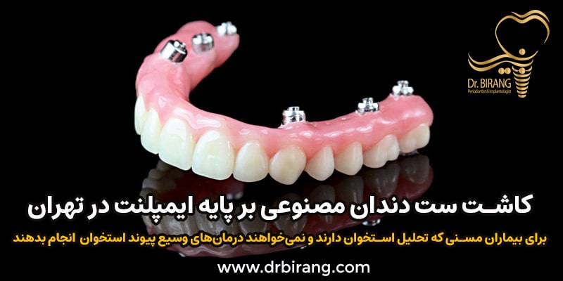 کاشت ست دندان مصنوعی بر پایه ایمپلنت در تهران توسط دکتر احسان بیرنگ متخصص ایمپلنت تهران