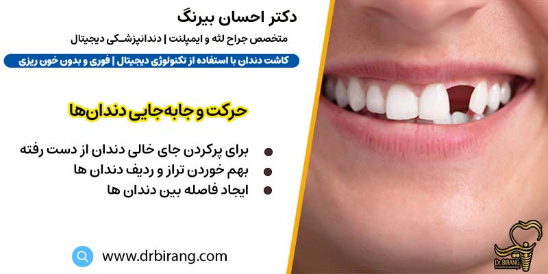 حرکت و جابه‌جایی دندان‌ها برای پرکردن جای خالی | دکتر احسان بیرنگ متخصص ایمپلنت در تهران