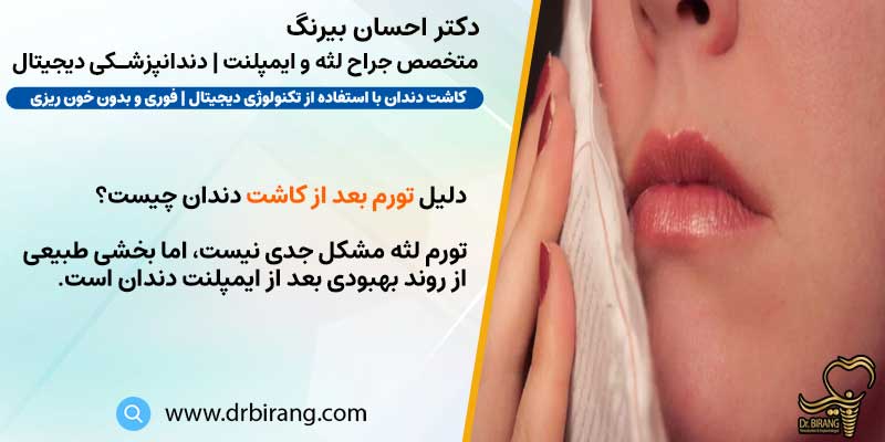 دلیل تورم بعد از کاشت دندان | دکتر احسان بیرنگ متخصص ایمپلنت
