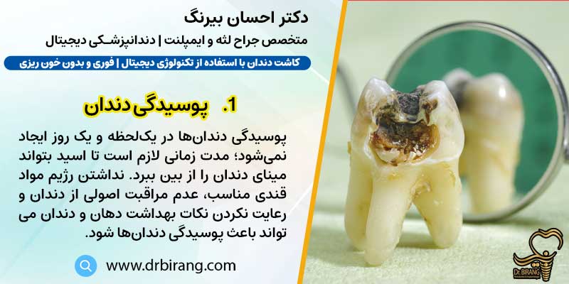 پوسیدگی دندان علت ازبین‌رفتن دندان‌ها | دکتر احسان بیرنگ متخصص ایمپلنت در تهران