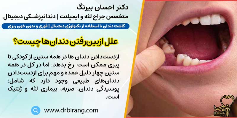 علت اصلی ازبین‌رفتن دندان‌ها چیست؟ | دکتر احسان بیرنگ متخصص ایمپلنت در تهران