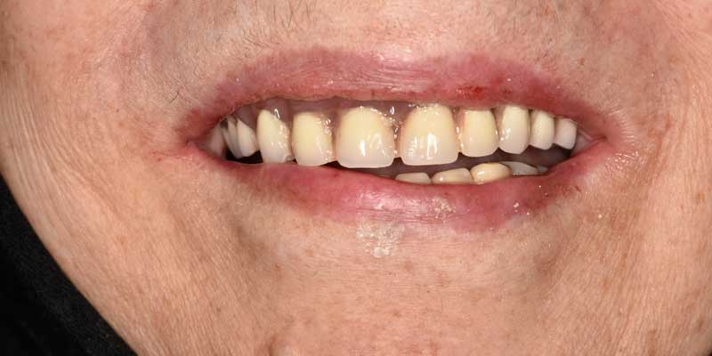 تبدیل دندان متحرک به ثابت با استفاده از ایمپلنت به روش All on 4 توسط دکتر احسان بیرنگ متخصص ایمپلنت تهران
