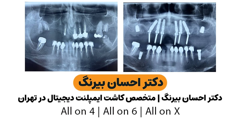 رادیوگرافی دندانپزشکی قبل و بعد از کاشت ایمپلنت به روش all on 6 توسط دکتر بیرنگ متخصص ایمپلنت تهران