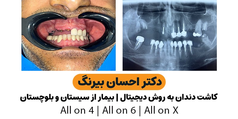 کاشت دندان دیجیتال به روش all on 6 | دکتر احسان بیرنگ