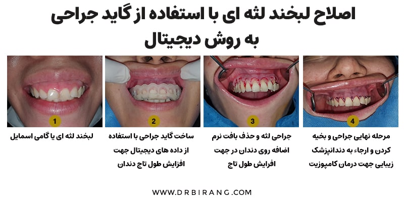 اصلاح لبخند لثه ای به روش دیجیتال | دکتر احسان بیرنگ متخصص ایمپلنت در تهران