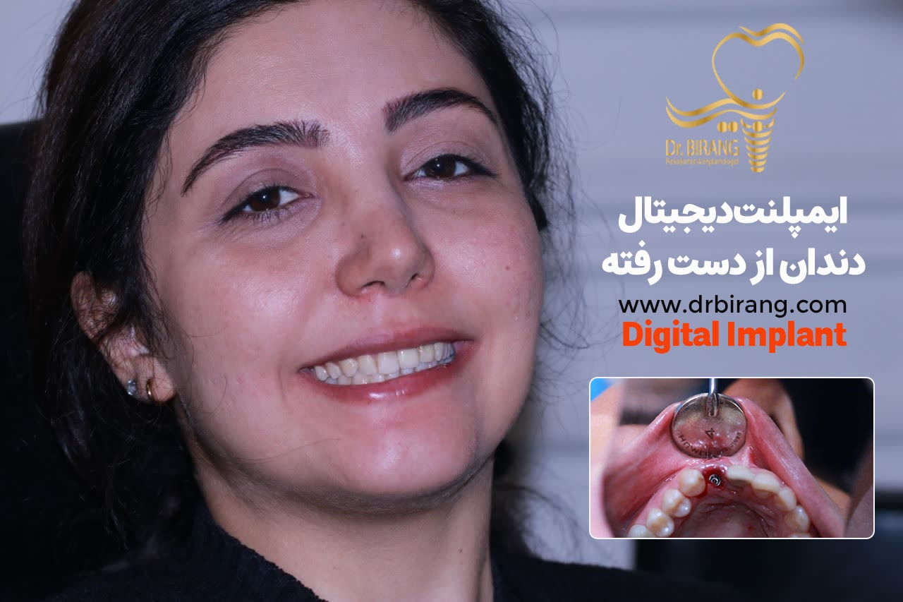 ایمپلنت دیجیتال دندان از دست رفته | دکتر بیرنگ متخصص ایمپلنت در تهران
