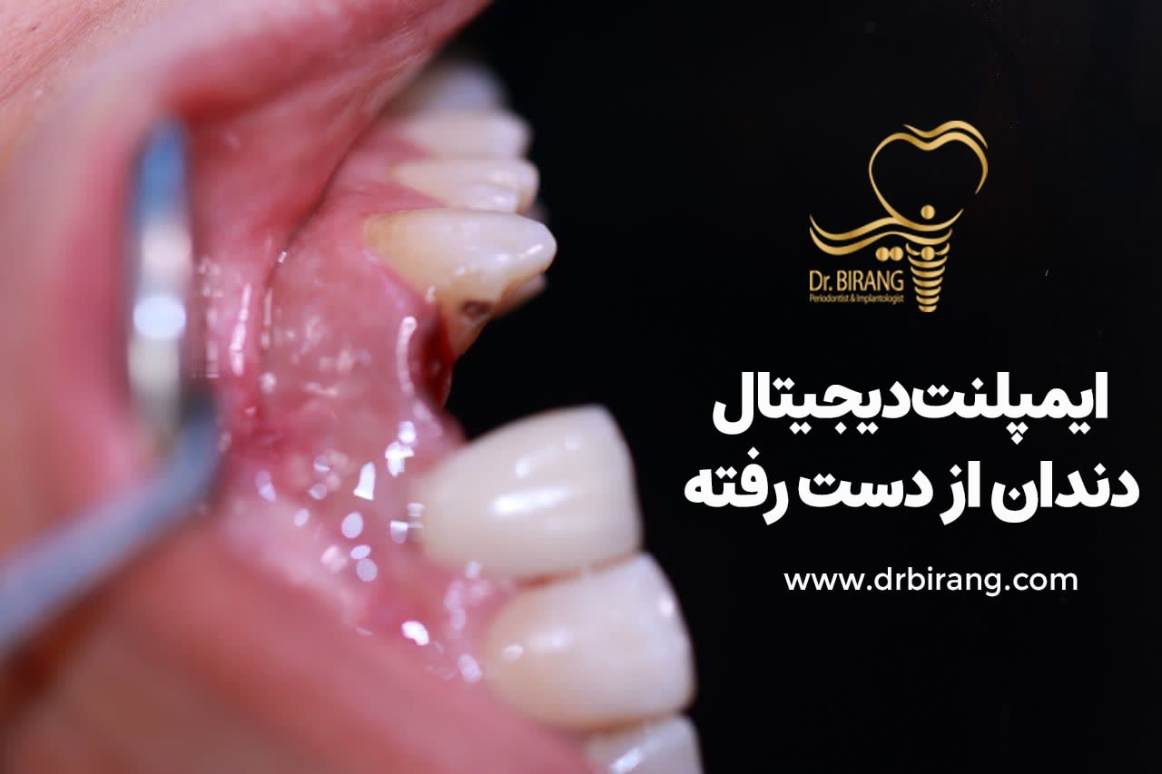 ایمپلنت دیجیتال دندان از دست رفته توسط دکتر احسان بیرنگ