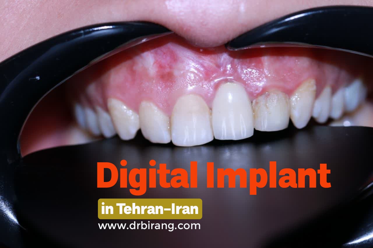 ایمپلنت دیجیتال دندان از دست رفته | دکتر بیرنگ متخصص ایمپلنت در تهران