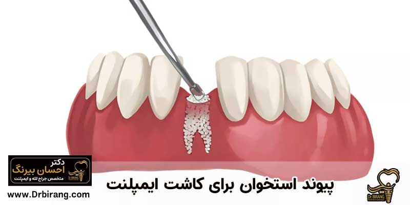 پیوند استخوان برای ایمپلنت دندان | دکتر احسان بیرنگ متخصص ایمپلنت در تهران