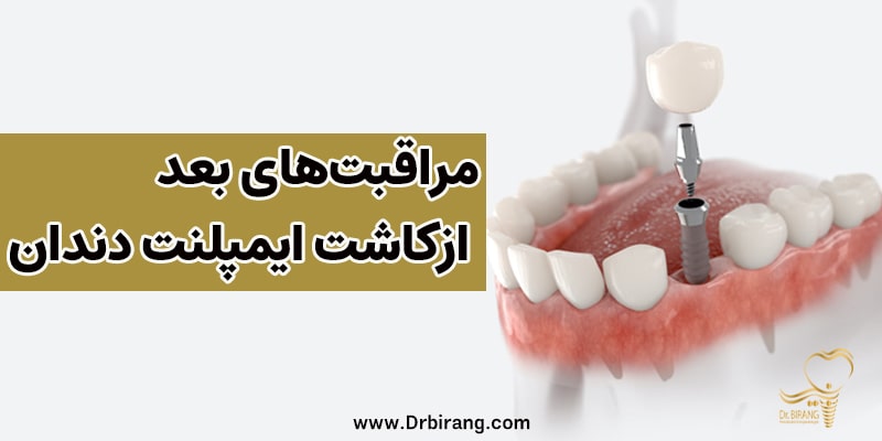 مراقبت‏ های بعد ازکاشت ایمپلنت دندان