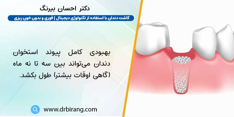 زمان بهبودی کامل پیوند استخوان دندان