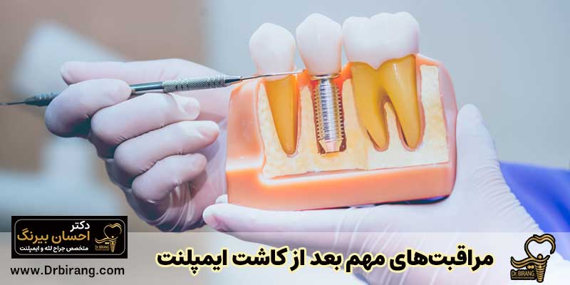 مراقبتهای مهم بعد از کاشت ایمپلنت دندان