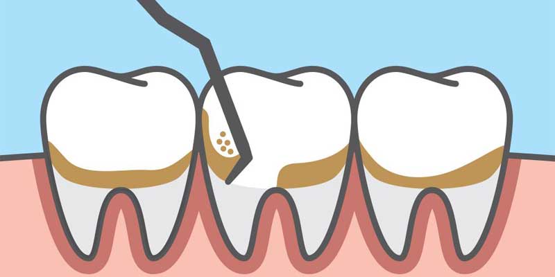 نکات مهم بعد از جرم گیری دندان