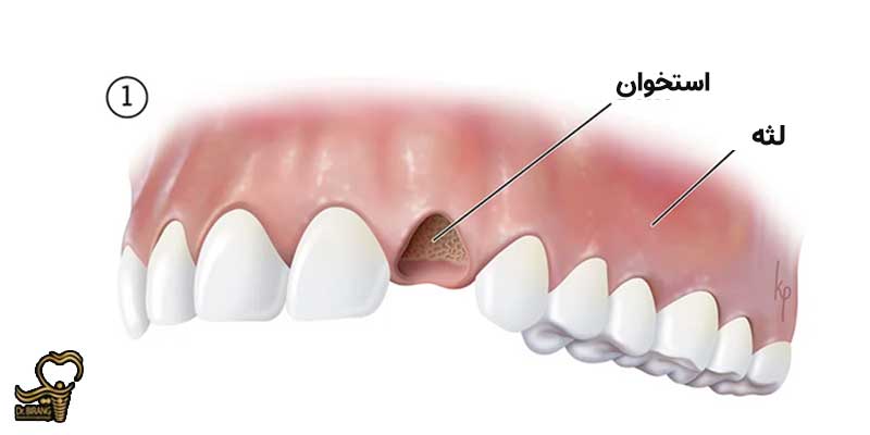 مراحل اول جراحی پیوند استخوان دندان