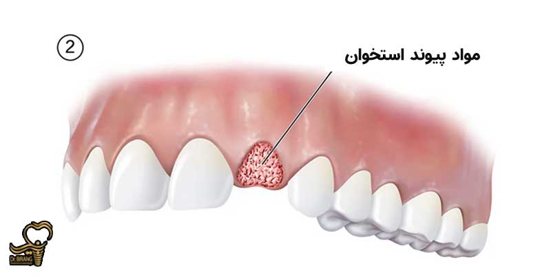مرحله دوم جراحی پیوند استخوان دندان