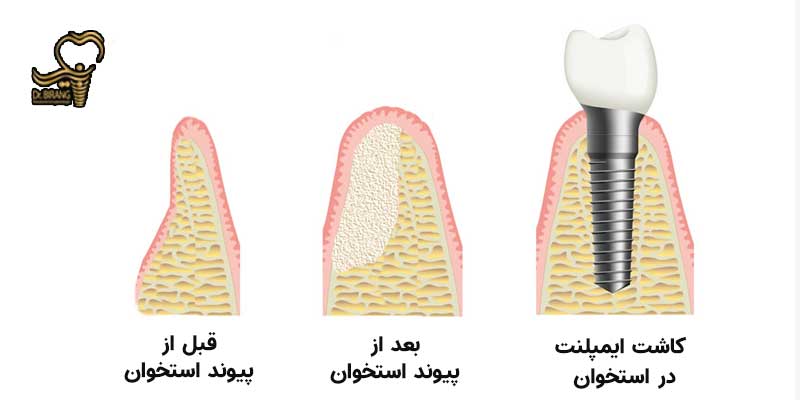 مراحل پیوند استخوان و کاشت ایمپلنت