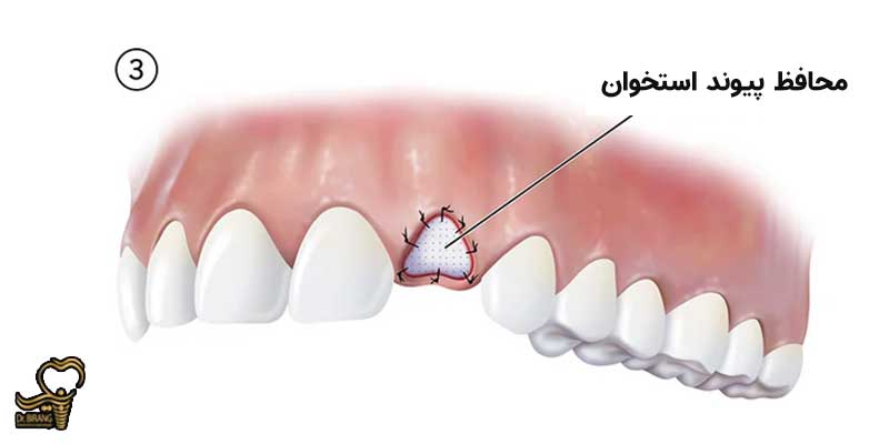 مرحله سوم جراحی پیوند استخوان دندان