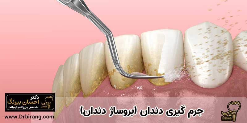 جرم گیری دندان (بروساژ دندان) | دکتر احسان بیرنگ متخصص ایمپلنت در تهران