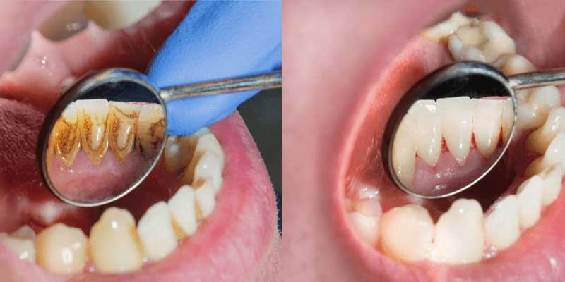 مزایای جرم گیری دندان و روت پلنینگ چیست؟