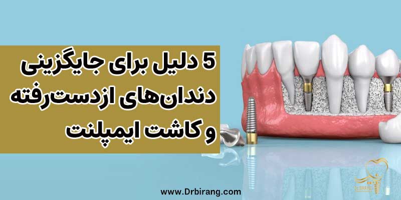 5 دلیل برای جایگزینی دندان های ازدست رفته و کاشت ایمپلنت