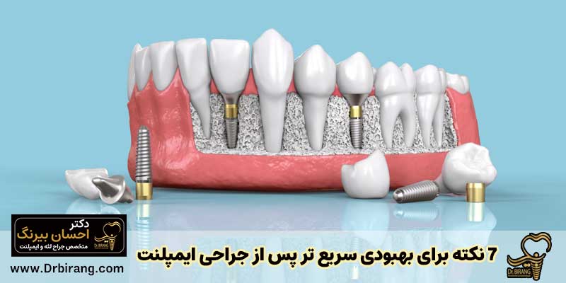7 نکته برای بهبودی سریع تر پس از جراحی ایمپلنت دندان