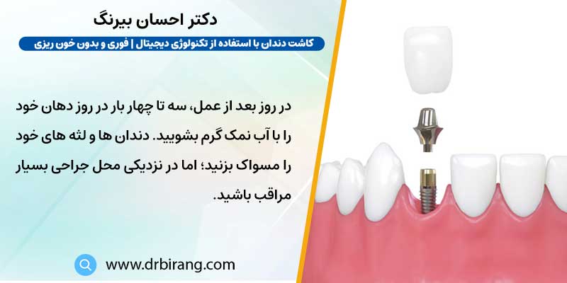مراقبت از ایمپلنت دندان پس از جراحی