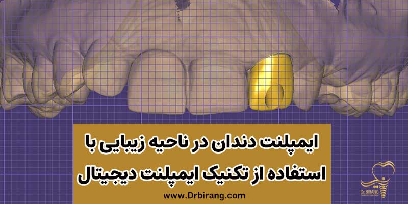 ایمپلنت دندان در ناحیه زیبایی با استفاده از تکنیک ایمپلنت دیجیتال در تهران