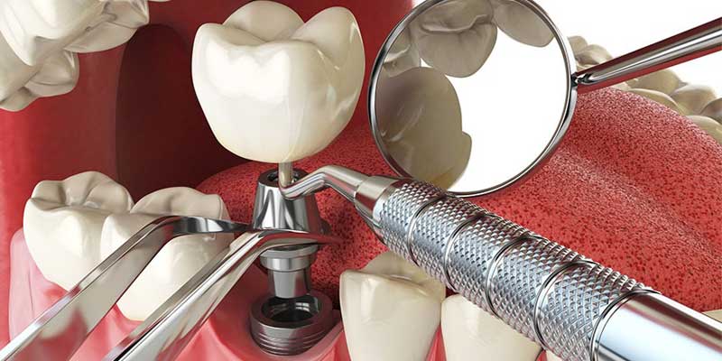 انواع ایمپلنت دندان از نظر روش جراحی