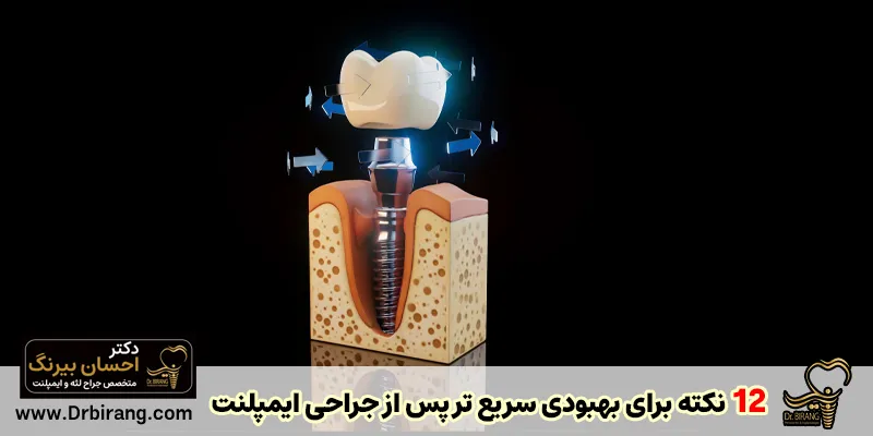 12 نکته برای بهبودی سریع تر پس از جراحی ایمپلنت دندان