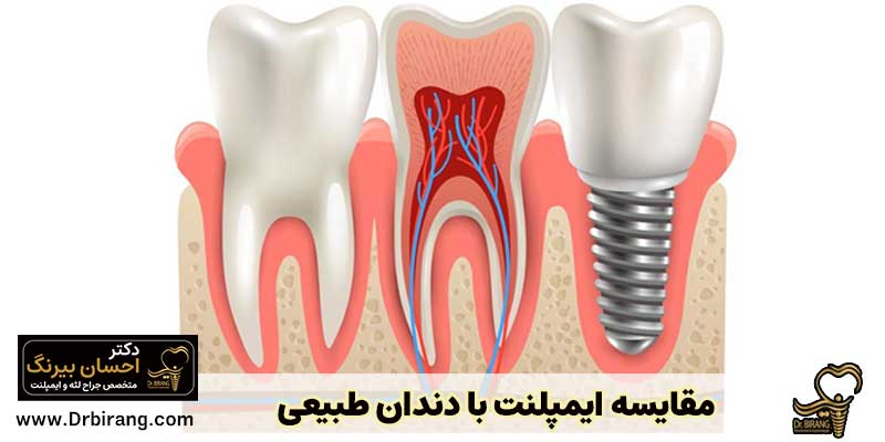 مقایسه ایمپلنت با دندان طبیعی | دکتر احسان بیرنگ