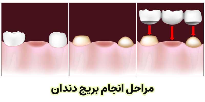 مراحل انجام بریج دندان