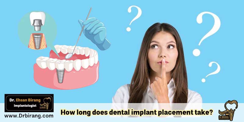 How long does dental implant placement take?
