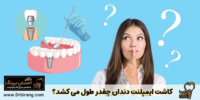 کاشت ایمپلنت دندان چقدر طول می کشد؟ | دکتر احسان بیرنگ