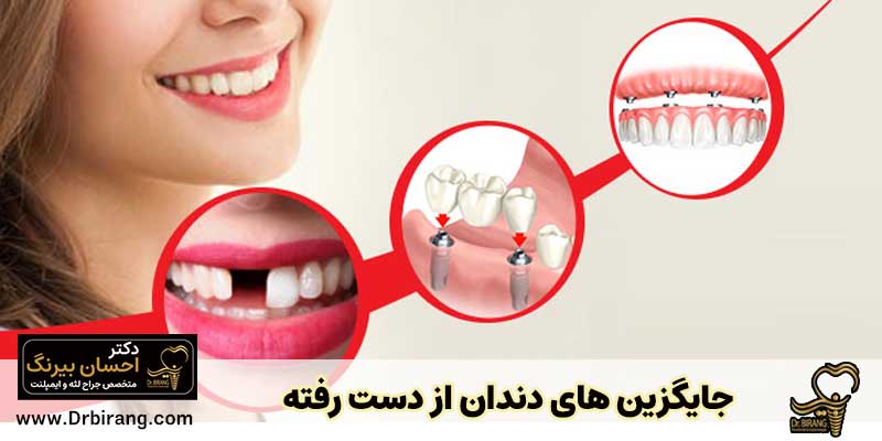 جایگزین های دندان از دست رفته | دکتر احسان بیرنگ