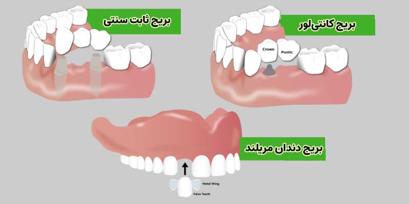 انواع بریج یا پل دندان